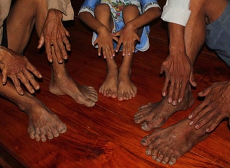 Bàn tay, bàn chân mỗi người đều có 6 ngón. (Ảnh: Tr.Châu)