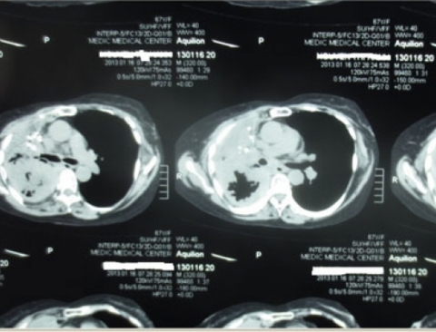 Ảnh chụp CT scanner cho bệnh nhân N.T.H - Ảnh: do Trung tâm Medic cung cấp