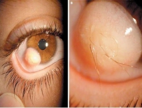 U bì kết giác mạc có thể gây mọc lông trong mắt. Ảnh: Shutterstock
