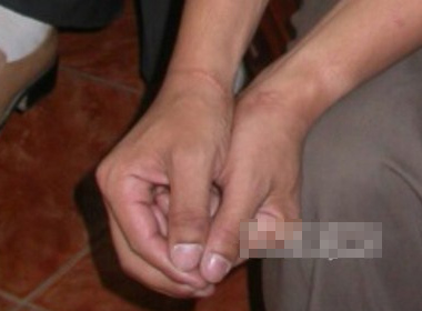 Theo tố cáo của anh Phạm Mạnh Hùng, các vết sẹo trên cổ tay là do các điều tra viên dùng còng số 8 khóa tay để treo anh lên.