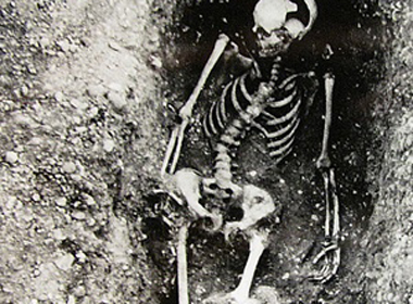 Bộ xương hóa thạch phát hiện thấy tại Stanlake (Anh) mang khối u kích thước bằng một trái bóng rổ ở phía chân trái.