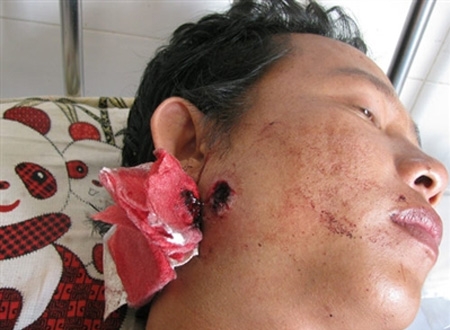 Anh Huỳnh Nhật Quang bị bắn ở mặt