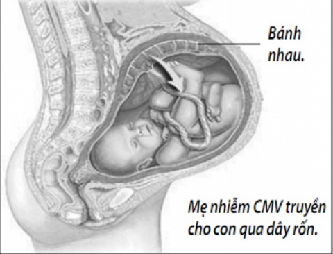 Mẹ nhiễm CMV truyền cho con qua dây rốn.