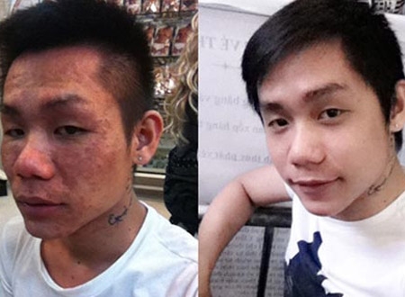 Cậu hot boy A.S trước và sau khi tiêm trắng với khuôn mặt biến dạng hoàn toàn