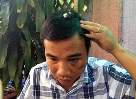 Nguyễn Nhật Trường với nhiều vết thương vùng đầu và mặt