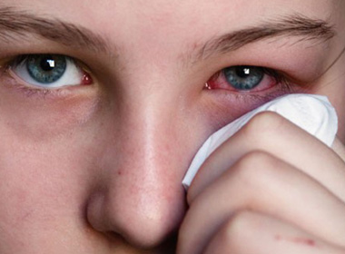 Bệnh đau mắt đỏ có thể lây nhiễm nếu do vi rút gây ra. Ảnh minh họa