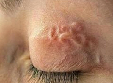 Ấu trùng ký sinh di chuyển dưới mí mắt trên khi ăn thịt chó.