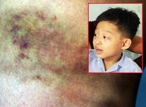 Bé Trương Quốc Việt bị cô giáo đánh đến tím đùi