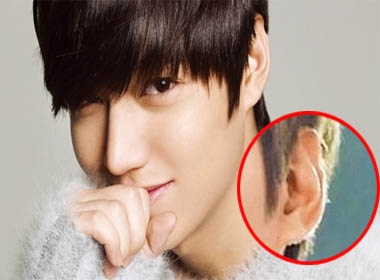 Lee Min Ho bị nghi lấy sụn tai nâng mũi