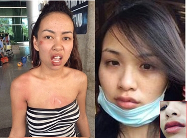 Hàng loạt sao Việt đã bị bầm tím mặt mày do bị cướp giật và bạo hành