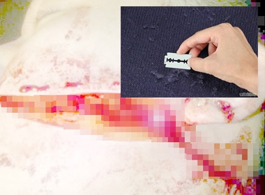 Vết rạch bằng dao lam để lại trên khuôn mặt nạn nhân ở Hải Phòng