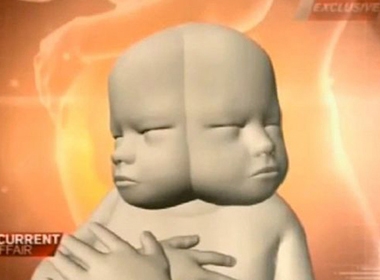 Bào thai có 2 khuôn mặt và 2 bộ não