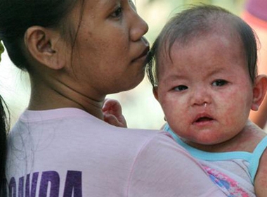 Một em bé với biểu hiện của bệnh sởi