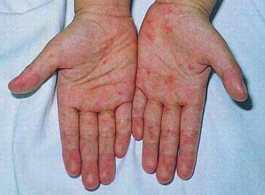 Bệnh tay chân miệng đang lan rộng. (Ảnh minh họa)