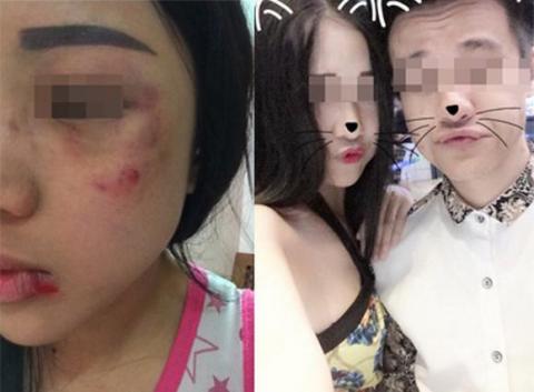 Cô gái Hà Thành bị bạn trai đánh bầm dập