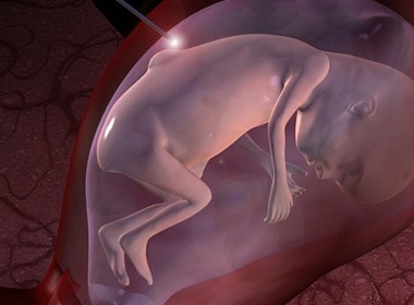 Công nghệ phẫu thuật bào thai ngay từ trong bụng mẹ