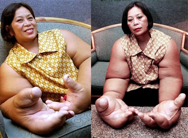 Người phụ nữ có đôi tay 'khủng' nhất thế giới, nặng 19kg