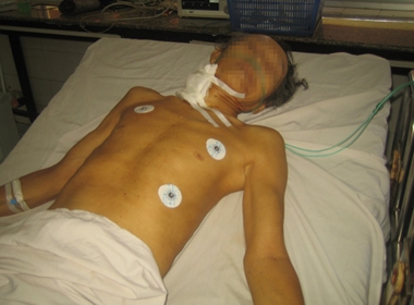 Ông Phạm Văn Bảy đang cấp cứu tại Bệnh viện đa khoa tỉnh Bình Phước