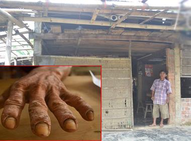 Thoát khỏi cơn đau bằng cách nhúng tay vào nước sôi vì không có tiền chữa bệnh