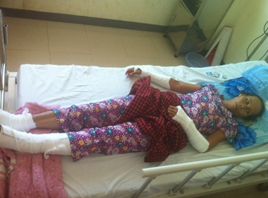 Bà Phan Thị Hạnh (46 tuổi, Thừa Thiên Huế) bị chồng đánh gãy tứ chi đang được điều trị tại bệnh viện