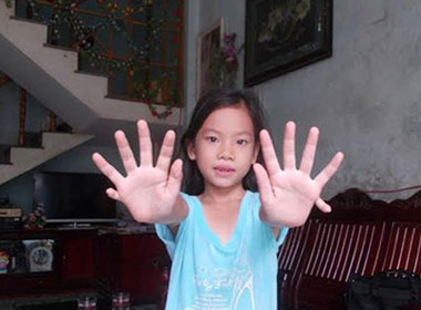 Cô bé có 24 ngón tay, chân ở Quảng Nam
