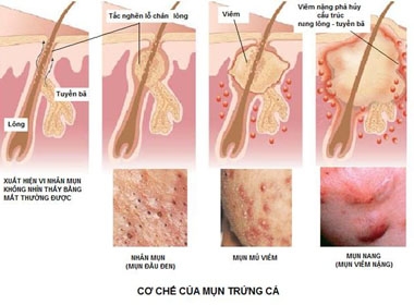 Cảnh báo dùng thuốc trị mụn có nguy cơ đẻ quái thai