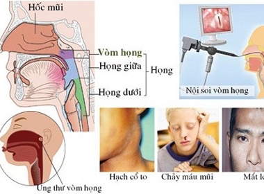 Ung thư vòm họng và những điều cần biết 