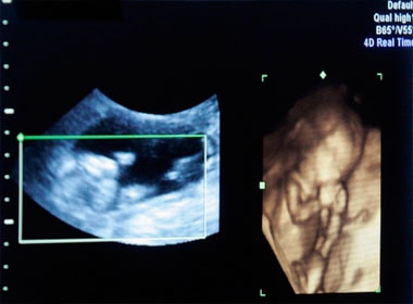 Kỳ tích phẫu thuật tim cho thai nhi trong bụng mẹ