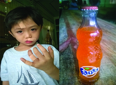 Cà Mau: Một chai Fanta bất ngờ phát nổ, bé 6 tuổi phải khâu nhiều mũi