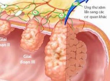 Vitamin & B1 thúc đẩy nhanh tiến triển bệnh ung thư.