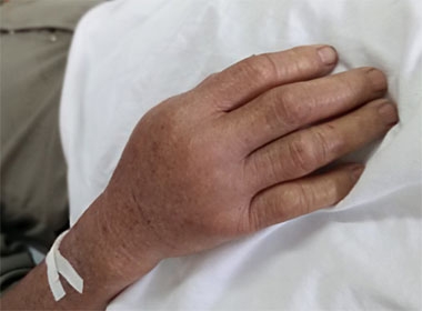 Một người dân xã Hòa Tân Tây, huyện Tây Hòa bị rắn lục đuôi đỏ cắn vào tay, đang điều trị tại bệnh viện