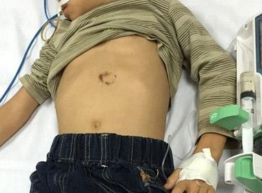 Bé trai 7 tuổi ngã vỡ đôi tụy khi tập xe đạp