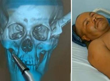 Hình ảnh chụp X-quang và Nunes sau khi phẫu thuật tại bệnh viện