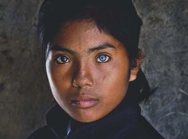 Cô gái có đôi mắt hai màu kỳ lạ ở Ninh Thuận