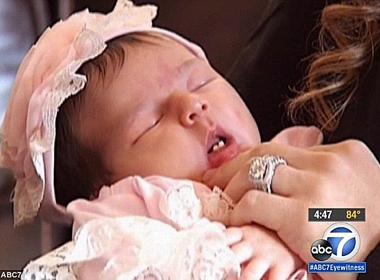 Bác sĩ sững sờ trước bé gái sơ sinh mới chào đời đã mọc 2 răng cửa
