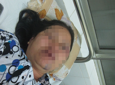 Bà Nguyễn Thị Hà bị hành hung dã man đang được điều trị tại bệnh viện
