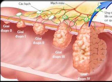 Nhận biết dấu hiệu ung thư dạ dày và phương pháp chữa trị