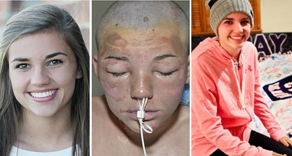 Cô gái 16 tuổi hồi phục nhanh kỳ diệu sau vụ cháy kinh hoàng