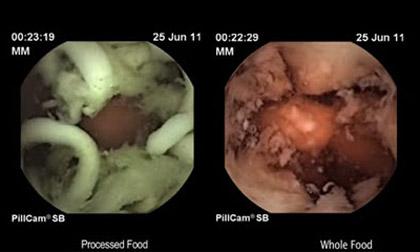 Sợi mỳ ăn liền nằm trong dạ dày 2h: Lời cảnh báo gây sốc