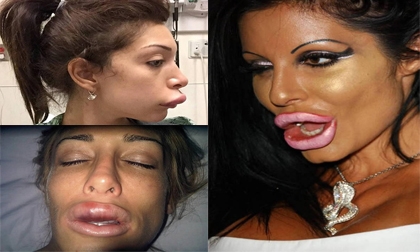 8 đôi môi kinh dị sau phẫu thuật thẩm mỹ
