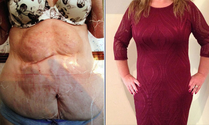 Karen Smith chi hơn 650 triệu phẫu thuật  bụng chảy xệ vì sợ chồng bỏ
