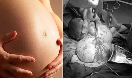 Người phụ nữ 'mang thai' 9 tháng 1... khối u