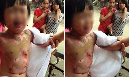 Cô chủ nhiệm giãi bày về vụ bé gái 3 tuổi bị bỏng ở trường mầm non