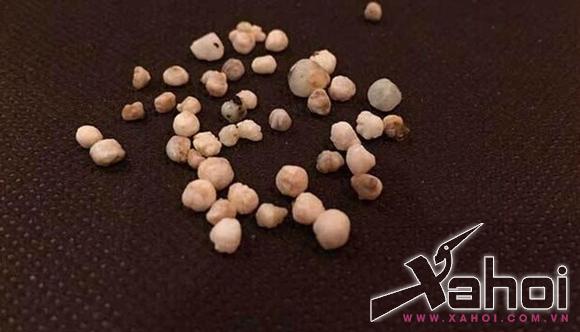 ăn phải 50 viên ngọc trai từ hải sản