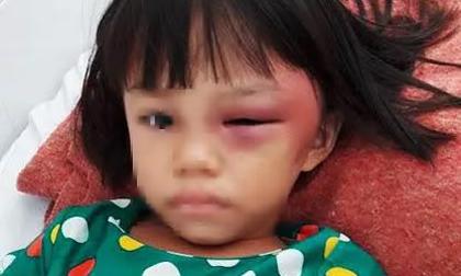 Bé gái bị mẹ kế đánh sưng mắt, châm thuốc lá bỏng tay