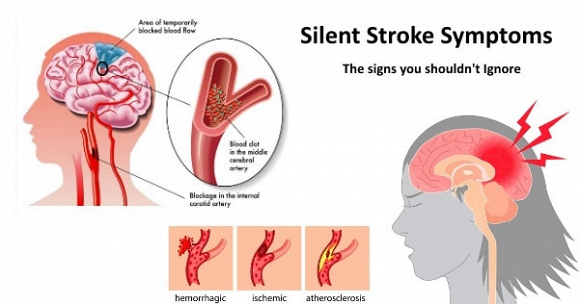 dấu hiệu cảnh báo đột quỵ 0