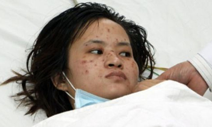 Bệnh viêm não mô cầu nguy hiểm như thế nào