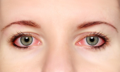 Cách phòng tránh đau mắt đỏ