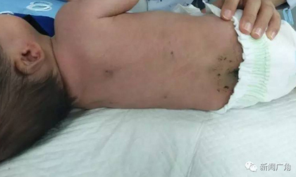Bé sơ sinh 40 ngày tuổi bị đâm 30 mũi kim vì bà ngoại tin bài thuốc dân gian 'chích máu'