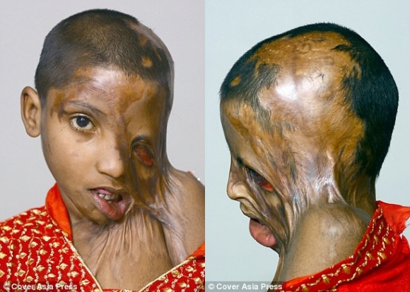 Bố tạt axit đánh ghen với mẹ, bé gái 4 tuổi trở thành nạn nhân đáng thương nhất với khuôn mặt hoàn toàn biến dạng - Ảnh 1.